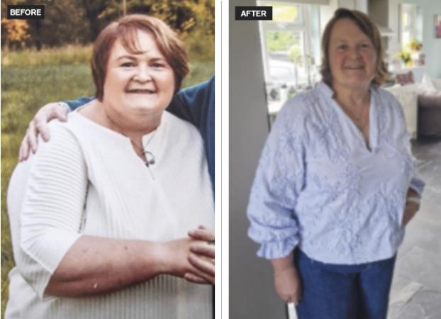 Bariatric surgery now a realistic option in Galway